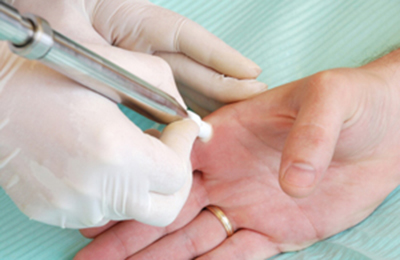 Cyrosurgery