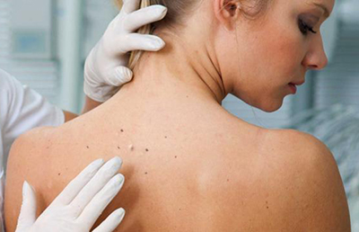 Cancer Screening